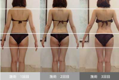 ハイパーナイフ効果